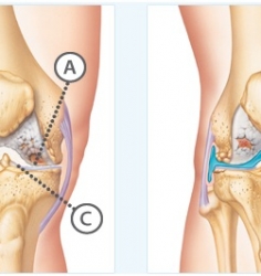 Knee arthritis and its symptoms