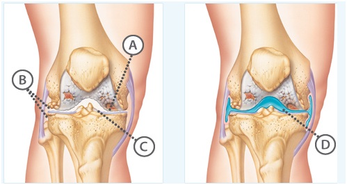 Knee arthritis and its symptoms