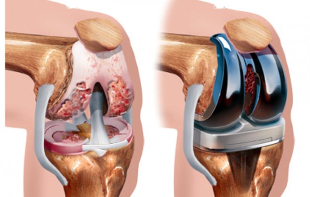 What is knee replacement؟