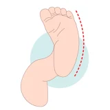 پاچنبری (Club-Foot)