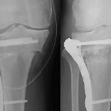 استئوتومی (Osteotomy)