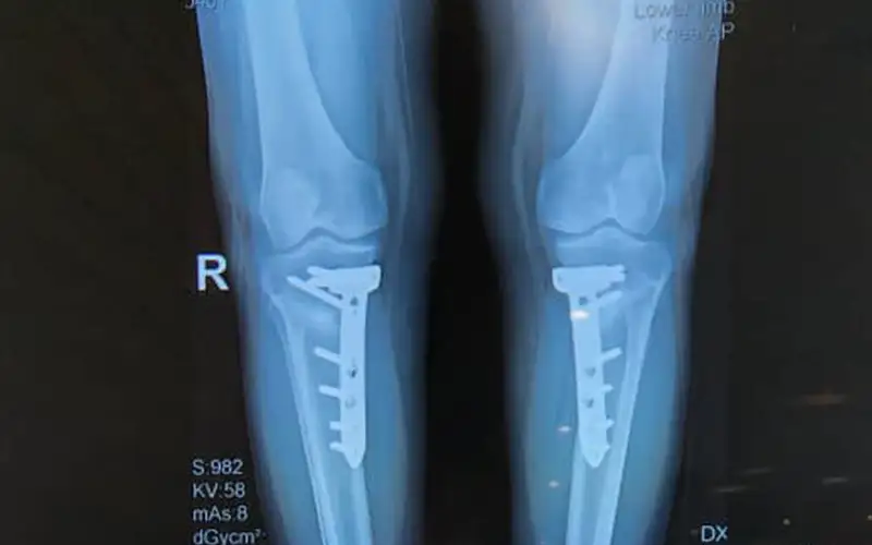 Osteotomy01.webp