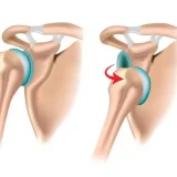 دررفتگی شانه