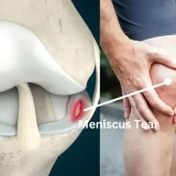 آسیب های مینیسک زانو