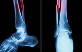 شکستگی استخوان