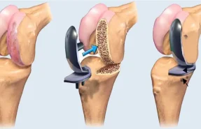 عمل تعویض مفصل زانو