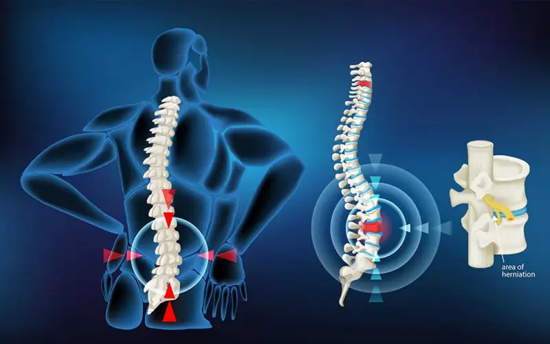 علائم دیسک کمر