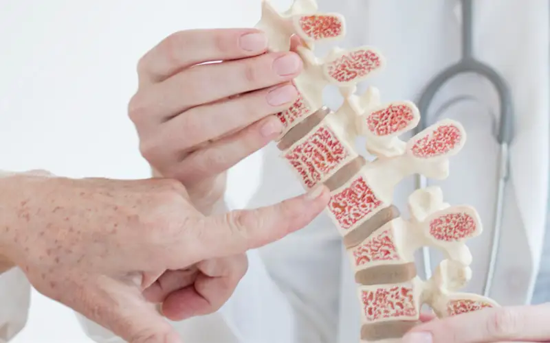 علت پوکی استخوان