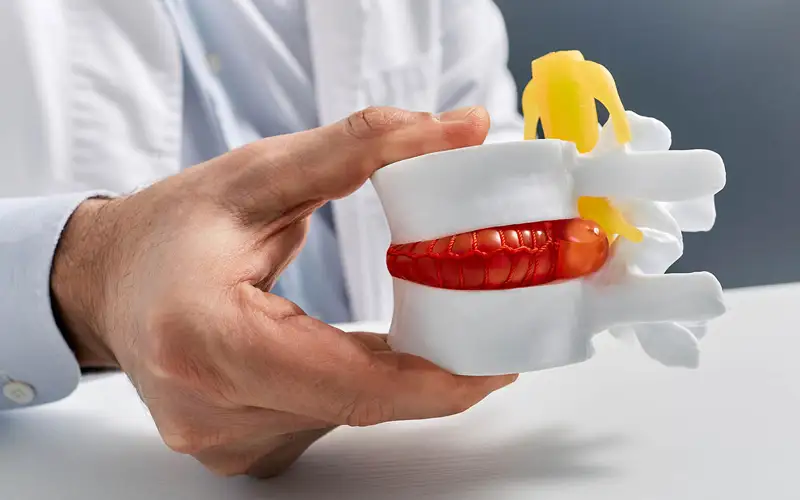 · جراحی تعویض دیسک کمر