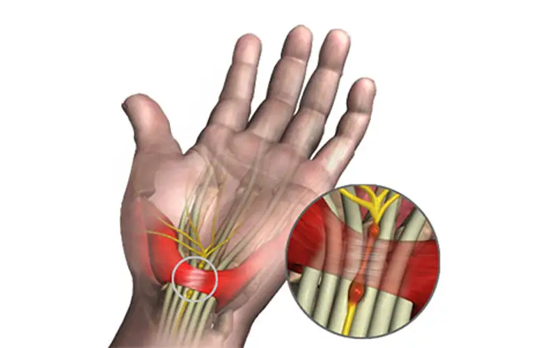 سندرم تونل کارپال