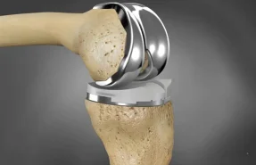 فواید جراحی تعویض مفصل زانو