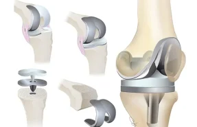 Special Clinical Tests for the Diagnosis of Meniscal Injuries