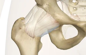 جراحی تعویض مفصل ران