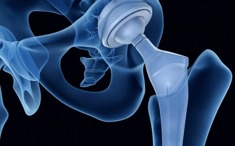 تعویض مفصل ران چیست؟