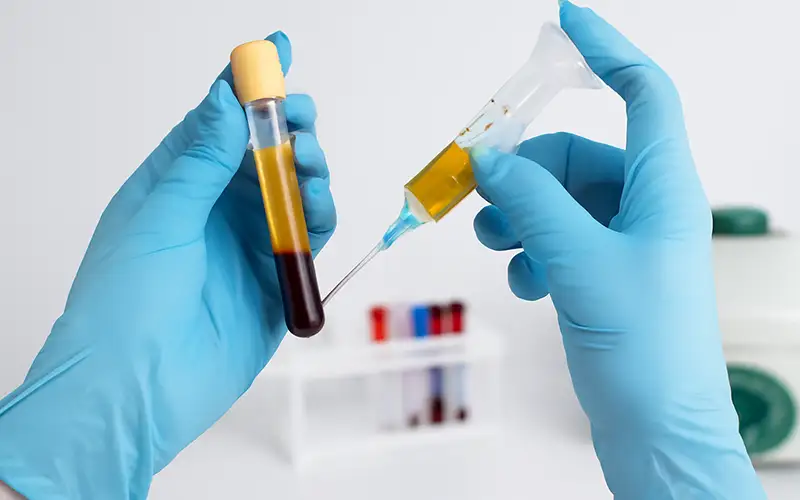 ACS یا Autologous Conditioned Serum