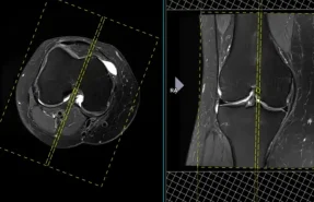 نقش MRI در تشخیص آسیب‌های منیسک
