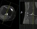 نقش MRI در تشخیص آسیب‌های منیسک