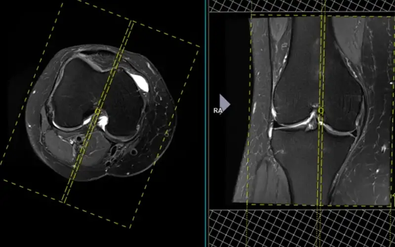 نقش MRI در تشخیص آسیب‌های منیسک