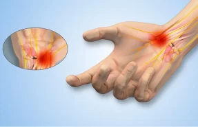 سندروم تونل کارپال (تونل مچ دست)