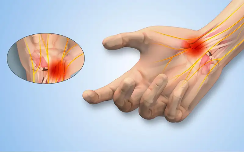 سندروم تونل کارپال (تونل مچ دست)
