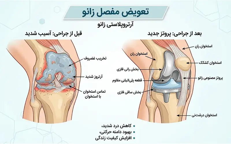 بررسی مراحل و تکنیک آرتروپلاستی زانو