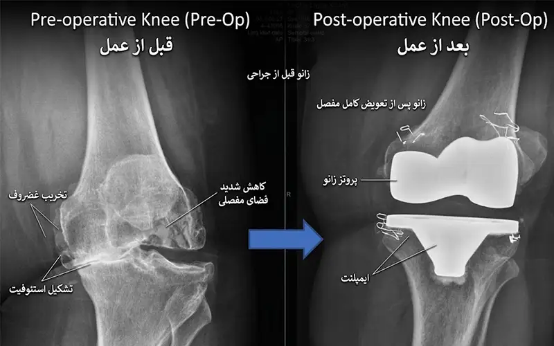 بررسی مراحل و تکنیک آرتروپلاستی زانو