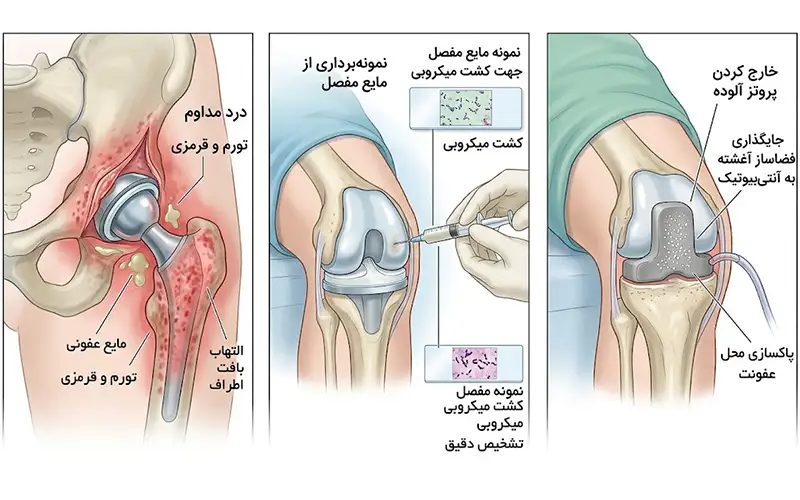 عفونت اطراف پروتز لگن و زانو چیست؟