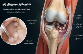 کندروماتوز سینوویال زانو چیست؟