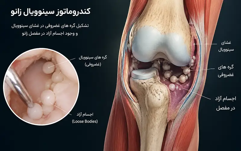 کندروماتوز سینوویال زانو چیست؟